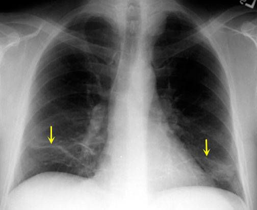 This is an example of plate like atelectasis (yellow arrows) in a