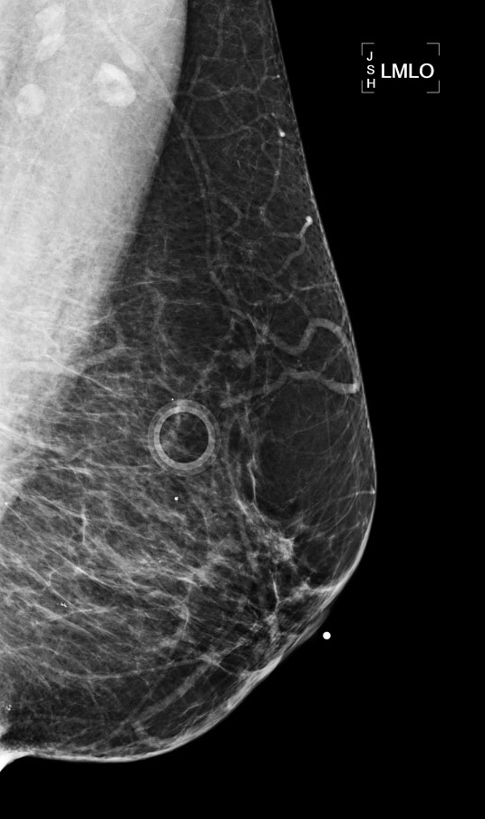 What happens after you get an abnormal mammogram?
