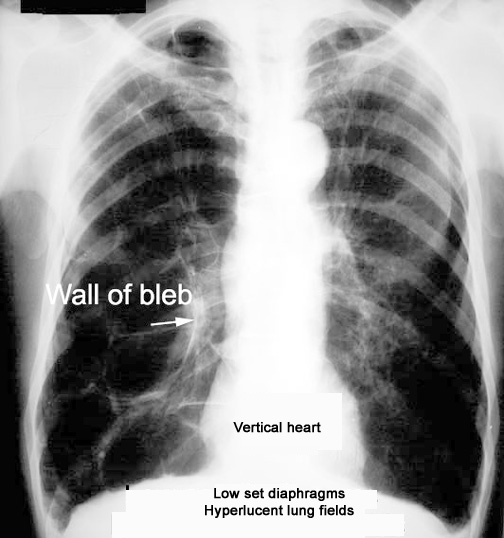 tubular heart