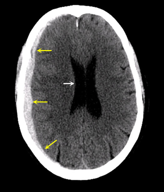Hematoma intracranial hemorrhage vs subdural cdn.bikemag.com