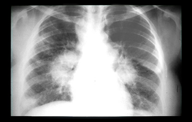 Image of Sarcoidosis - Lymphadenopathy