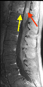 A: MRI (thoracic & lumbar) with and without contrast.