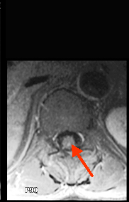 A: MRI (thoracic & lumbar) with and without contrast.