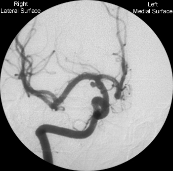 Anterior Cerebral Artery - Coronal Plane