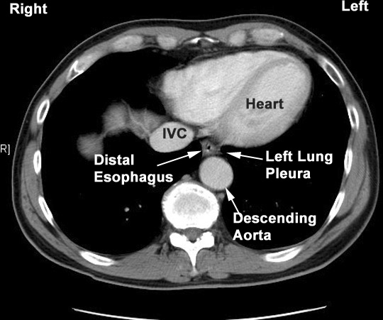 Course of Esophagus