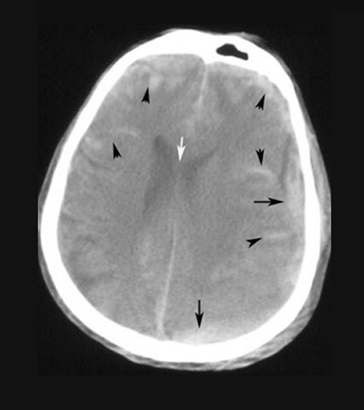 The subarachnoid hemorrhage (SAH) stages. The yellow arrows