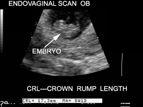 Normal Crown Rump Length Image Atlas of Normal Pregnancy